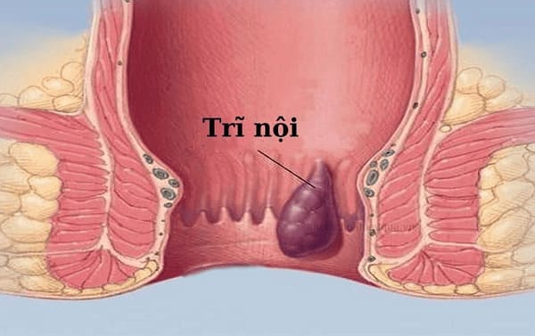 Bị trĩ nội là sao?