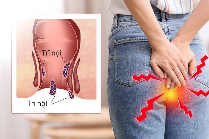 Bị trĩ nội ảnh hưởng như thế nào tới sức khỏe?