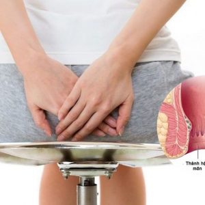 Cách nhận biết bệnh trĩ nội