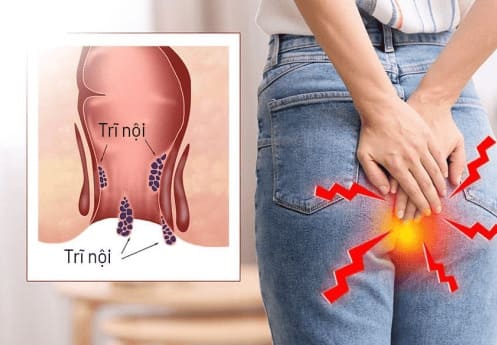 Cách nhận biết bệnh trĩ nội nhanh chóng, chính xác