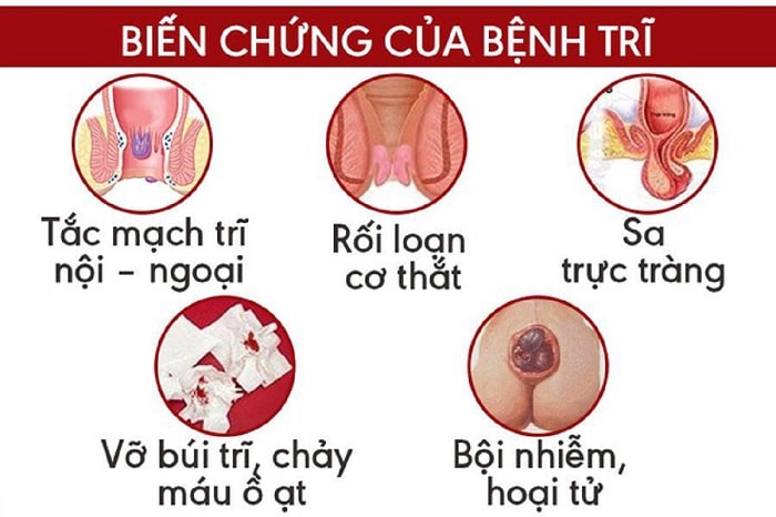 Biến chứng bệnh trĩ tuyệt đối không chủ quan