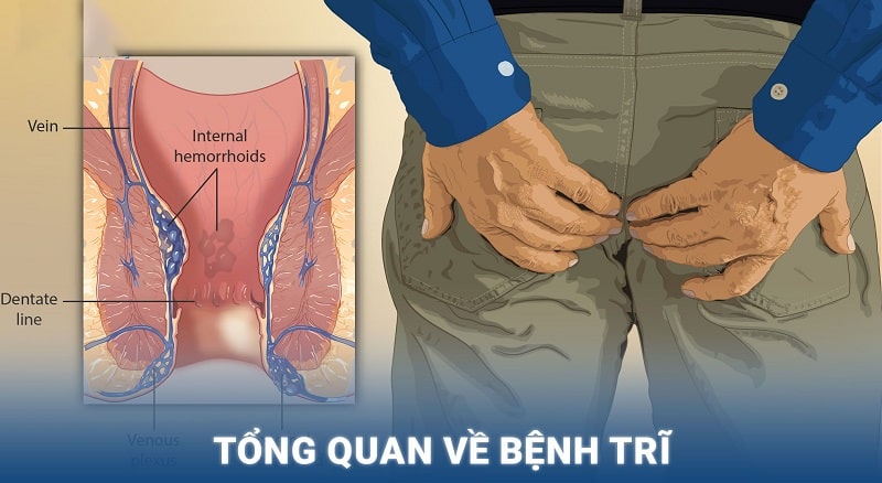 Tổng quan về bệnh trĩ và những điều cần biết