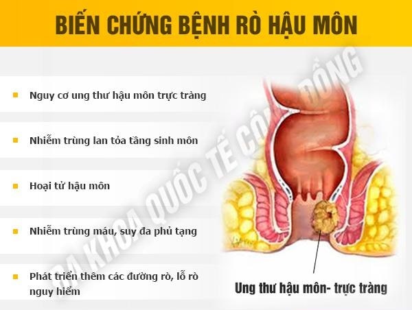 Rò hậu môn có nguy hiểm không ? Ảnh hưởng ra sao?