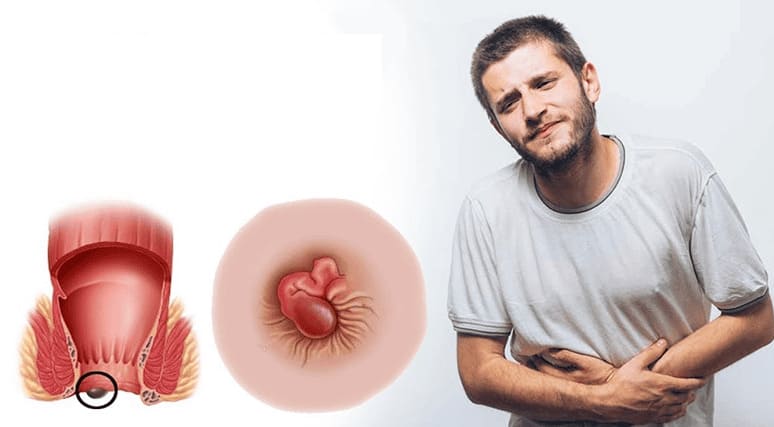 Bệnh trĩ - bệnh trĩ ngoại là gì?