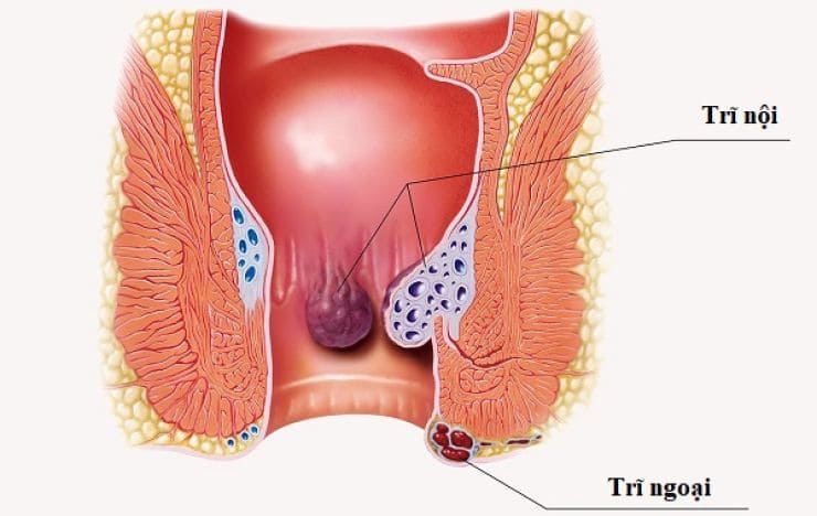 Trĩ là bệnh lý như thế nào?