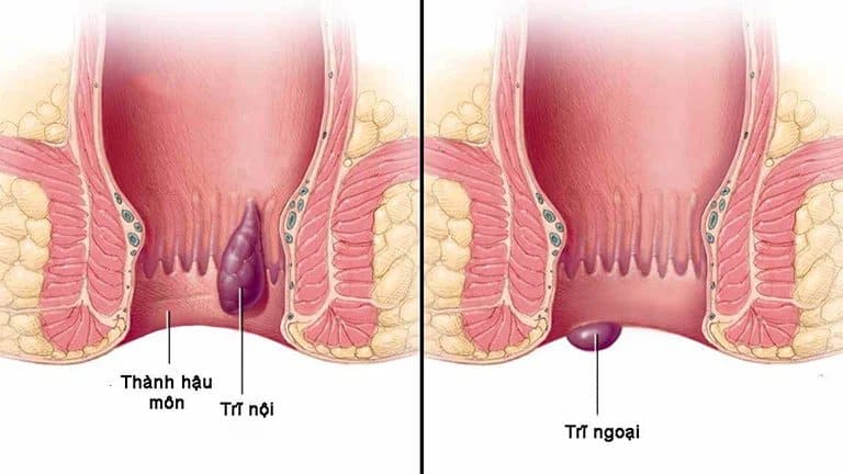 Trĩ nội và trĩ ngoại khác nhau như thế nào?
