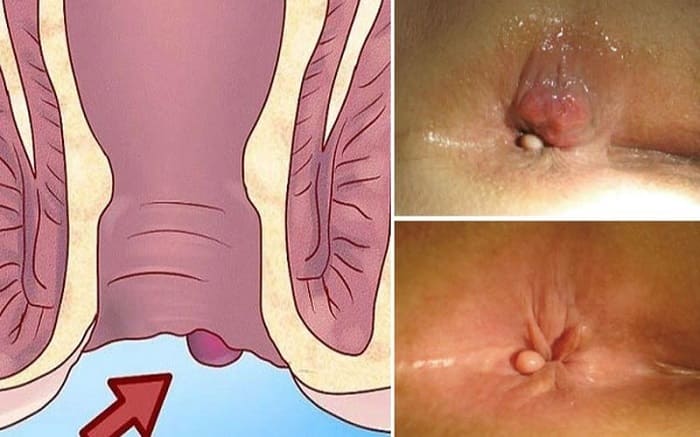 Trĩ ngoại là bệnh lý như thế nào?