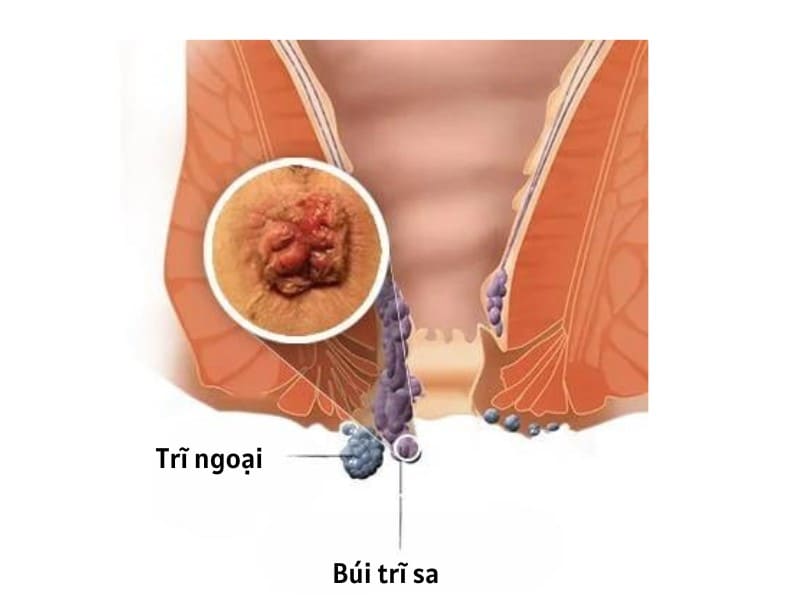 Sa nghẹt búi trĩ