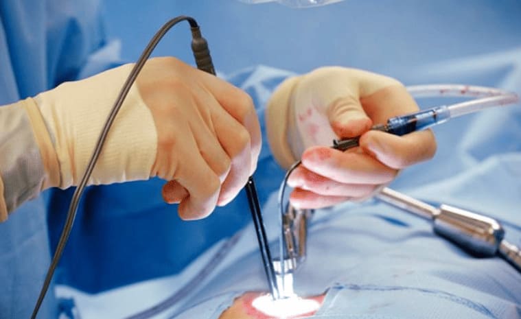 Tiến hành mổ trĩ ngoại tắc mạch