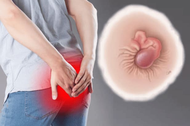 Bị tắc mạch trĩ ngoại có nguy hiểm không?