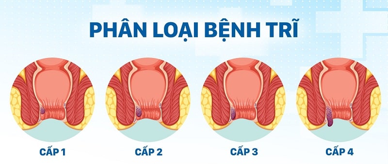 Xác định đúng cấp độ bệnh trĩ trước khi dùng thực phẩm chức năng chữa trĩ