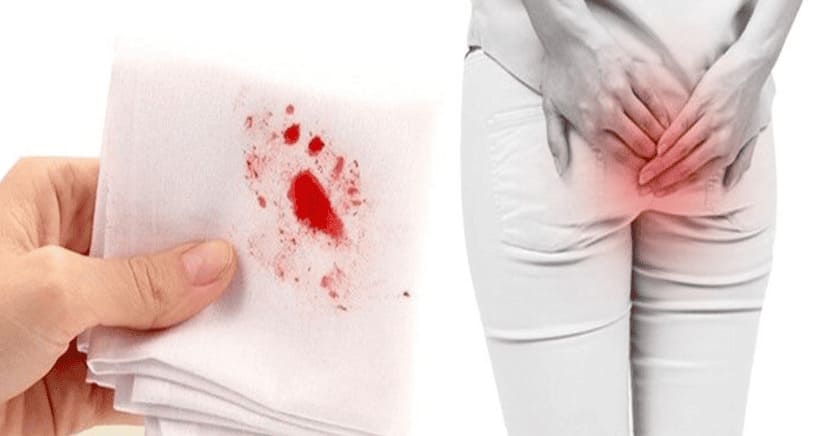 Triệu chứng bệnh trĩ ngoại