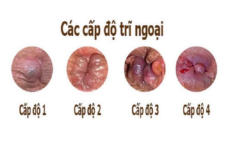 4 giai đoạn trĩ ngoại