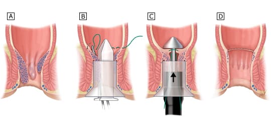 Chữa bệnh trĩ bằng phương pháp Longo