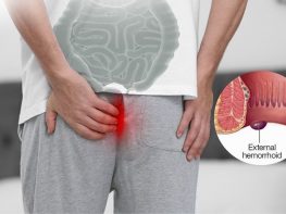 Bệnh trĩ ngoại có nguy hiểm không
