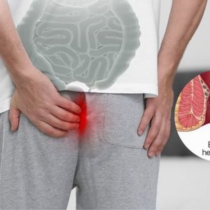 Bệnh trĩ ngoại có nguy hiểm không