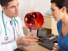 Chữa polyp hậu môn ở đâu