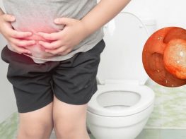 Hình ảnh bệnh polyp hậu môn