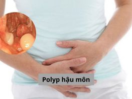 Polyp hậu môn