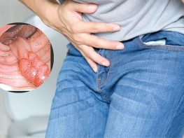Polyp hậu môn ác tính