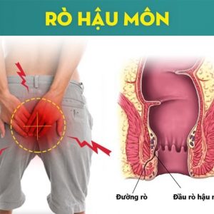Hiểu sao cho đúng về bệnh rò hậu môn? Đâu là dấu hiệu khi mắc bệnh?