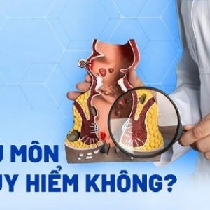 Thực hư bệnh rò hậu môn có nguy hiểm hay không?