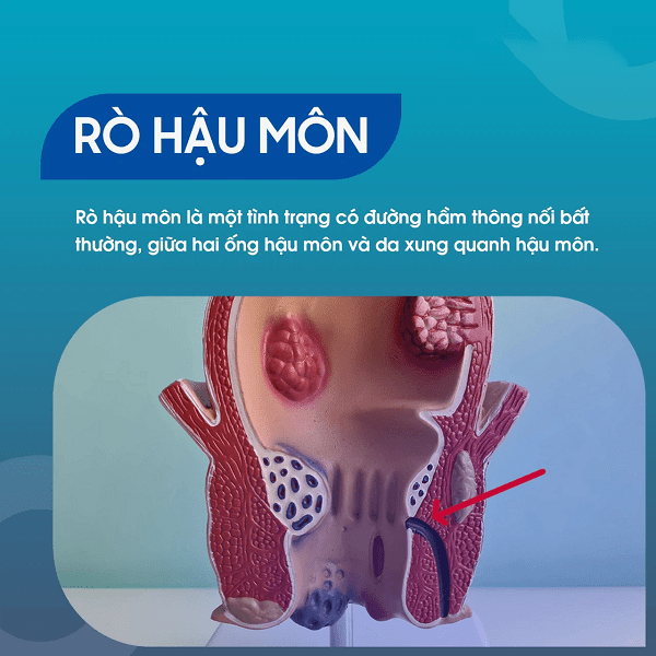 Thế nào là rò hậu môn? Bệnh lý này hình thành do đâu ?