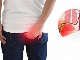 Thực hư về việc bệnh rò hậu môn có tái phát không?