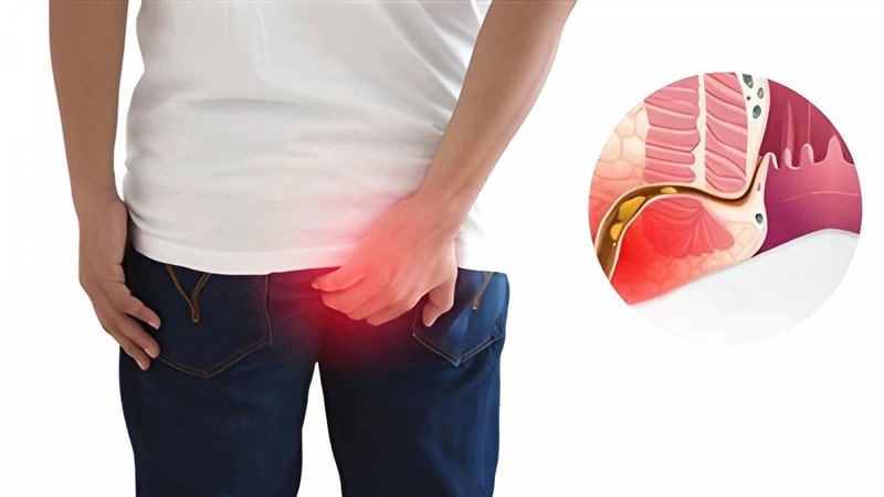 Thực hư về việc bệnh rò hậu môn có tái phát không?