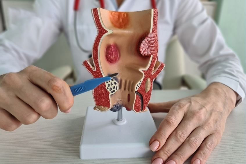 Làm sao để hạn chế tối đa nguy cơ mắc rò hậu môn ?