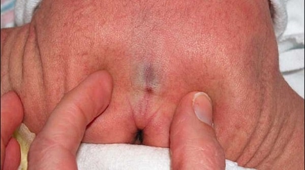 Đâu là biểu hiện của rò hậu môn ở trẻ sơ sinh?