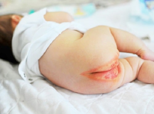 Nguy hiểm rò hậu môn ở trẻ sơ sinh tuyệt đối không nên xem nhẹ