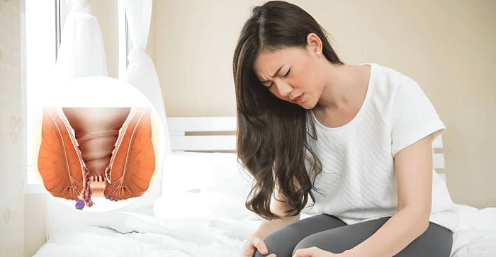 Trĩ ngoại sau sinh ở phụ nữ