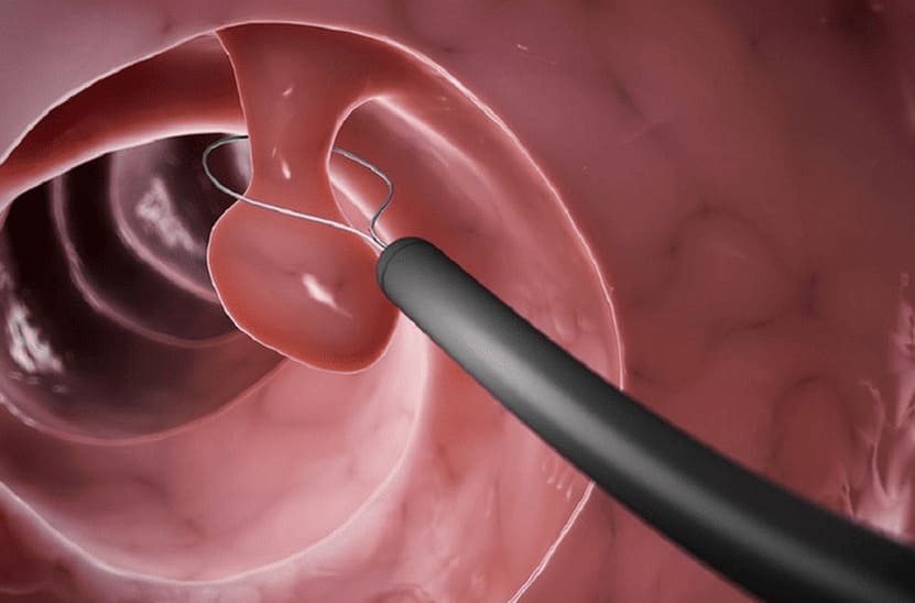 Cắt polyp hậu môn có đau không?