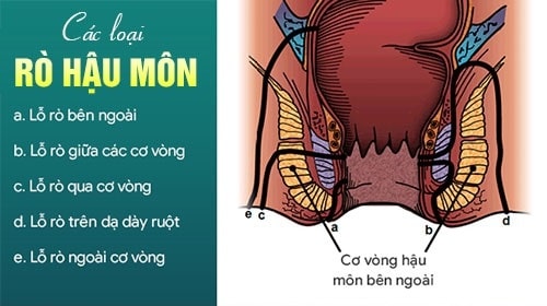 Các yếu tố quyết định đến chi phí mổ rò hậu môn cần chuẩn bị