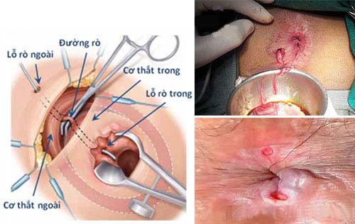 Vì sao cần mổ rò hậu môn ?