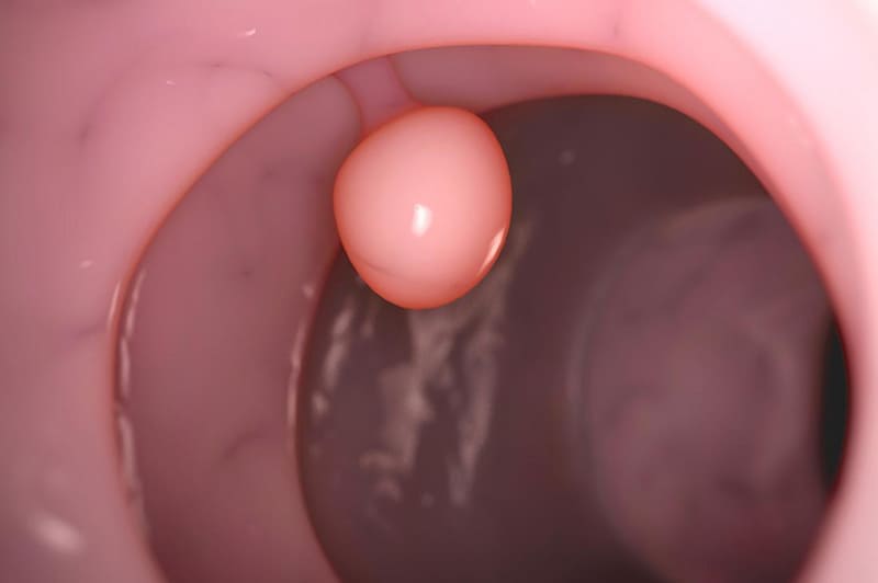 Một số thông tin về bệnh polyp