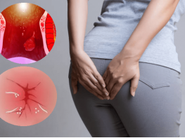 Cách phòng ngừa triệu chứng đại tiện ra máu và ngứa hậu môn