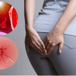 Cách phòng ngừa triệu chứng đại tiện ra máu và ngứa hậu môn