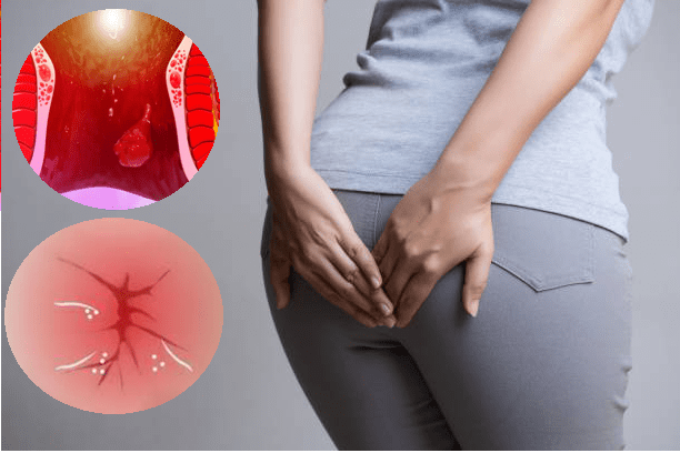 Cách phòng ngừa triệu chứng đại tiện ra máu và ngứa hậu môn