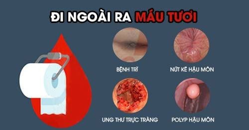 Nguyên nhân đi đại tiện ra máu và ngứa hậu môn