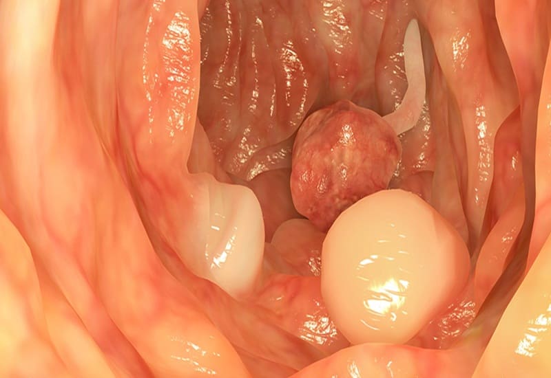 Polyp hậu môn là gì?