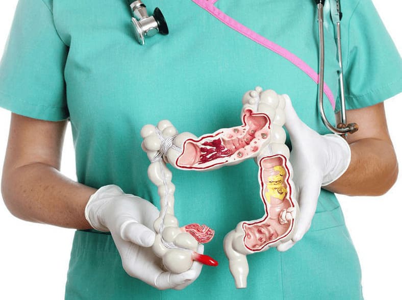 Điều trị bệnh polyp hậu môn hiệu quả
