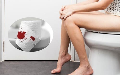 Tác hại từ Polyp hậu môn