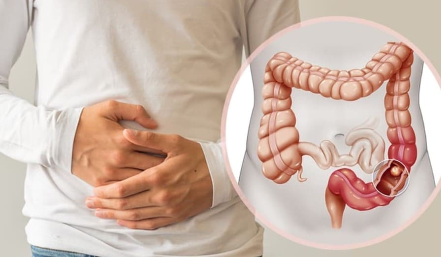 Dấu hiệu chung của bệnh polyp hậu môn