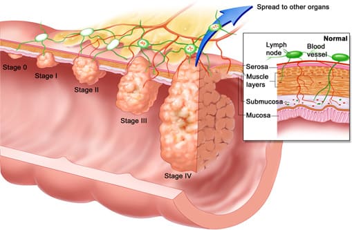 Dấu hiệu polyp đặc trưng theo từng loại bệnh