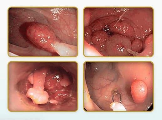 Polyp hậu môn