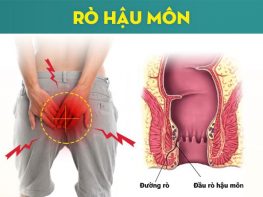 Cập nhật chung về bệnh lý rò hậu môn