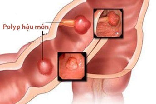 Bệnh Polyp hậu môn là gì?