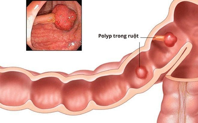 Bệnh lý polyp hậu môn